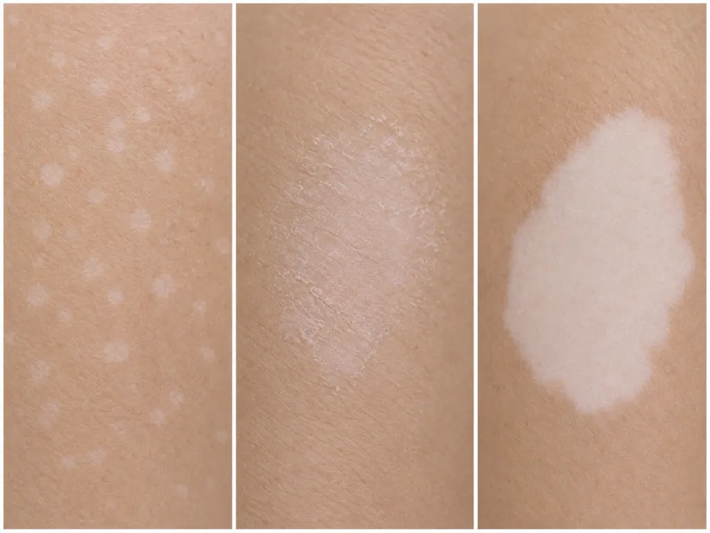 Illustrated comparison of different pale skin spot patterns without labels