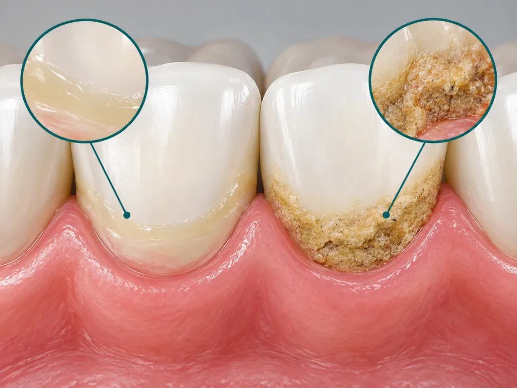 Educational illustration of soft plaque and hardened tartar on a tooth surface.